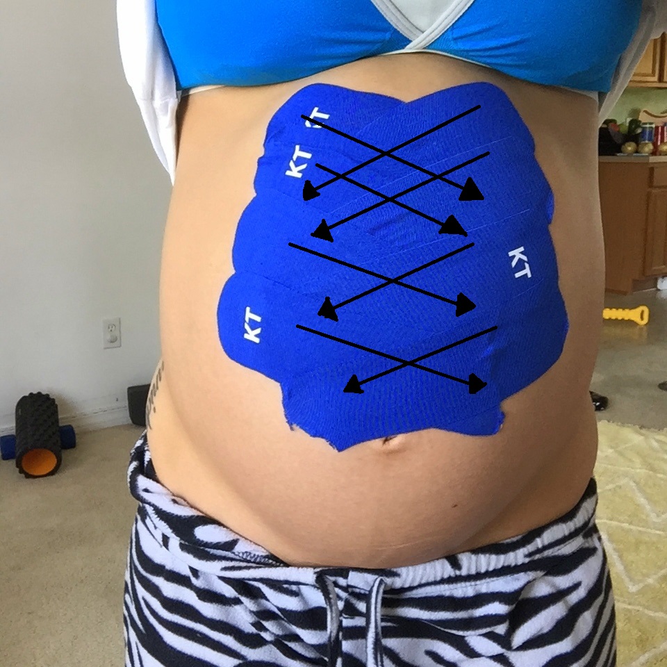 Diastasis Recti From Pregnancy